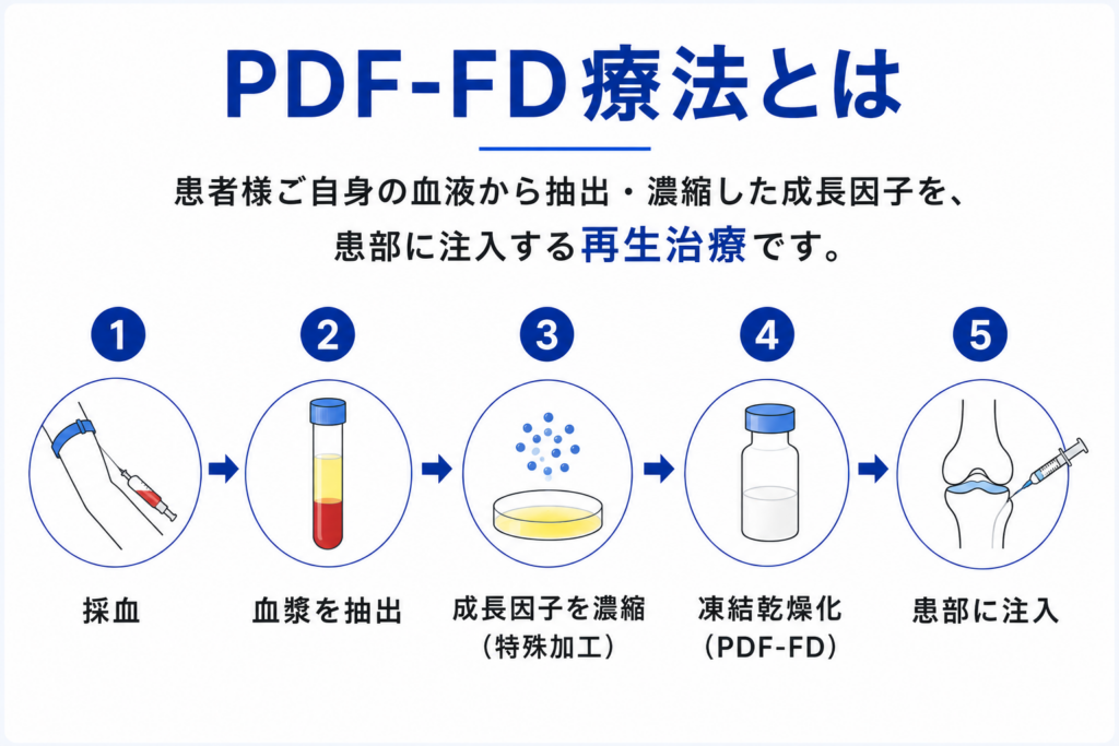 PDF-FD療法とは。①採血②血漿を抽出③成長因子を濃縮(特殊加工)④凍結乾燥化(PDF-FD)⑤患部に注入
